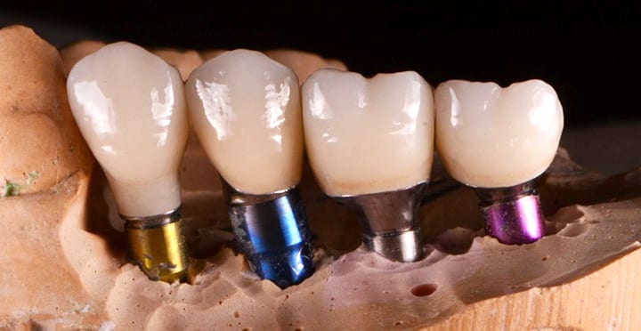 What are Dental Implants? Towson MD