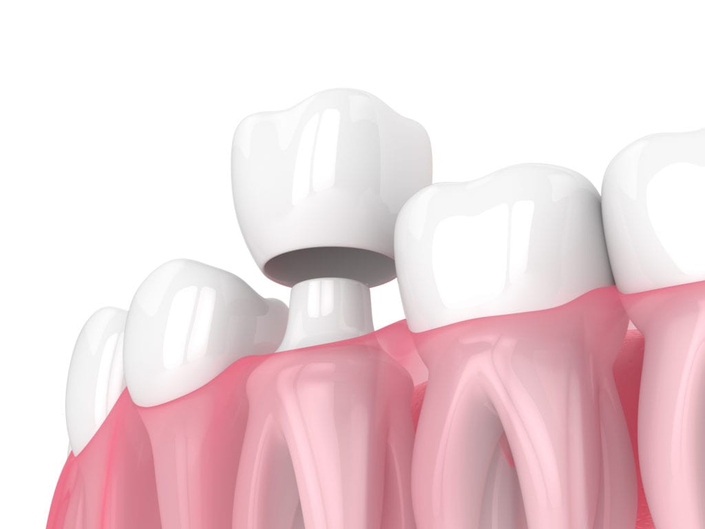 Dental Crowns in Towson, Maryland