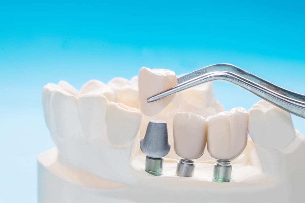 Dental Implants in Towson, Maryland