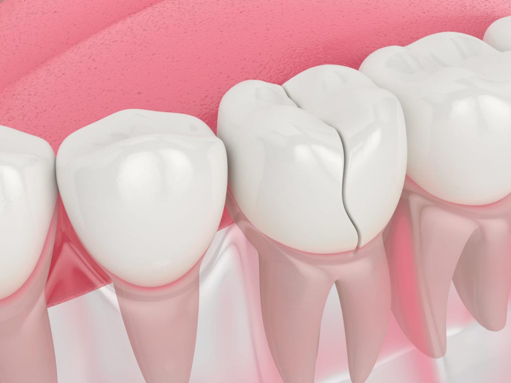 Treating Tooth Damage in Towson, Maryland