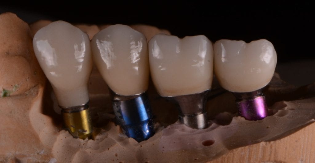 Dental Implants in Towson, Maryland