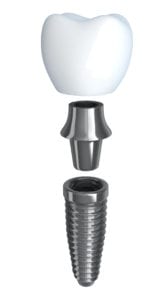 Dental Implants FAQs Towson MD