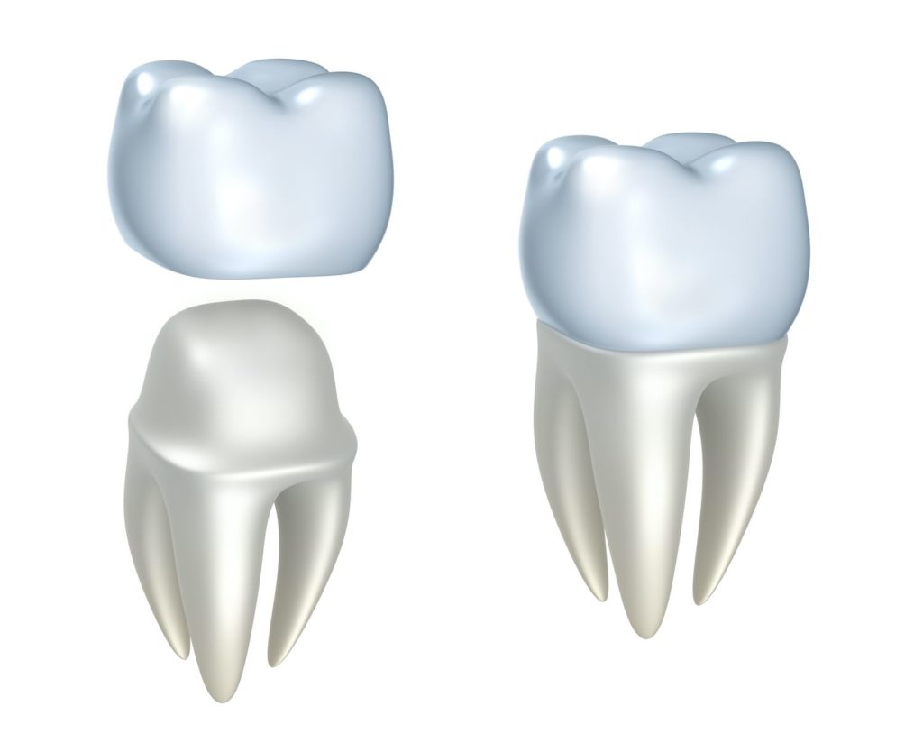 dental crown benefits in Towson Maryland