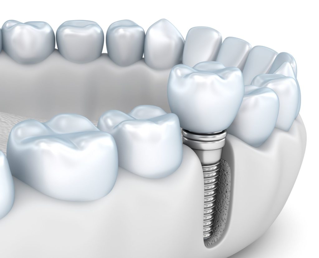 tooth replacement treatment Towson Maryland