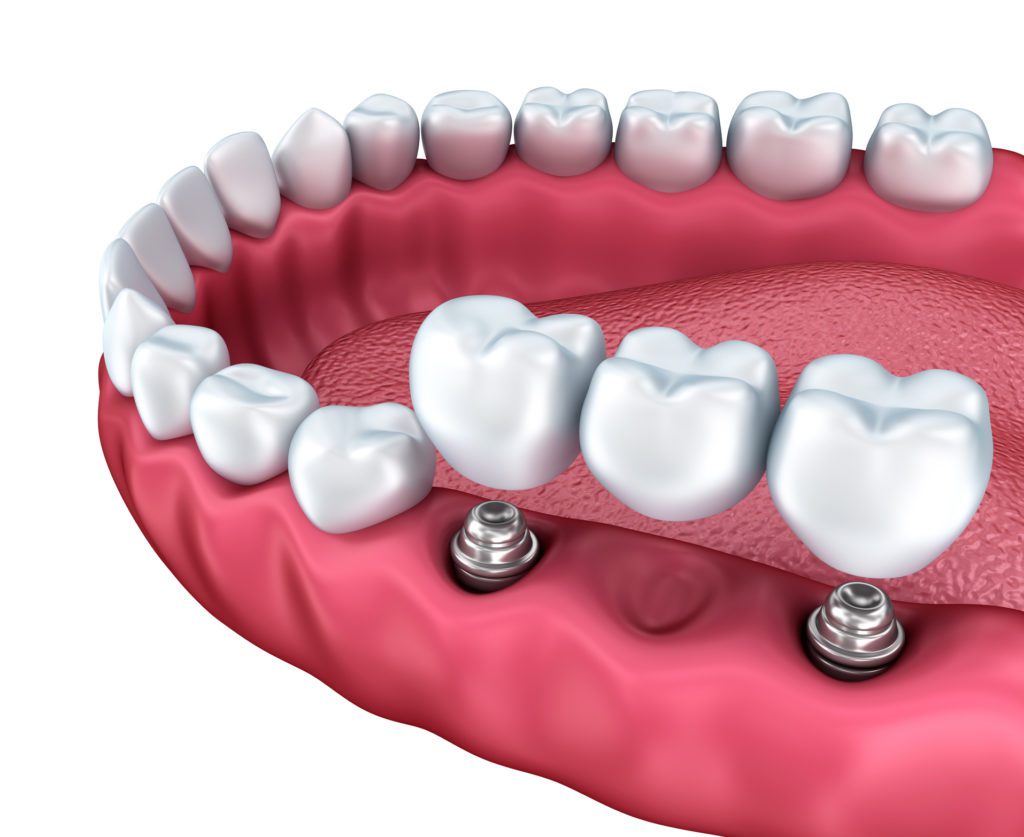 Multiple Dental Implants Towson MD
