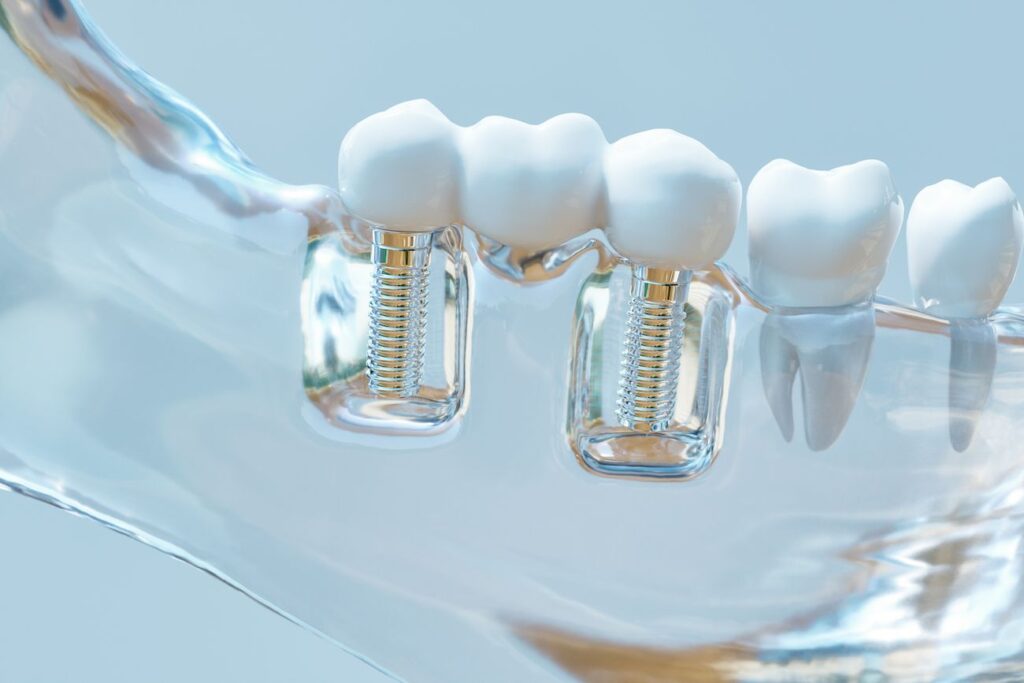 dental implant failure prevention tips