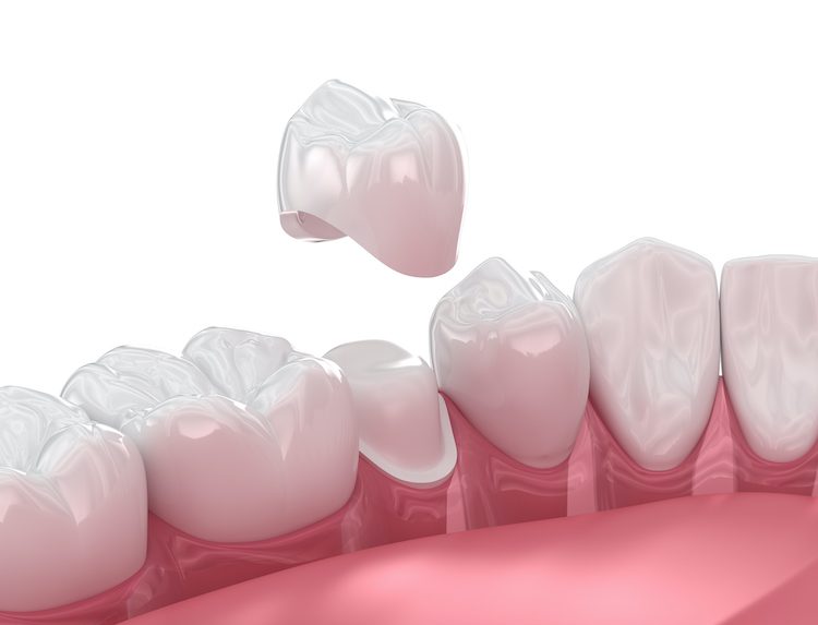 Knowing what to expect before, during, and after dental crown treatment can help ease anxiety and create a smooth recovery process.